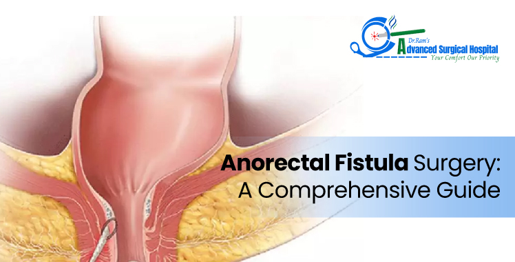 Anorectal Fistula Surgery