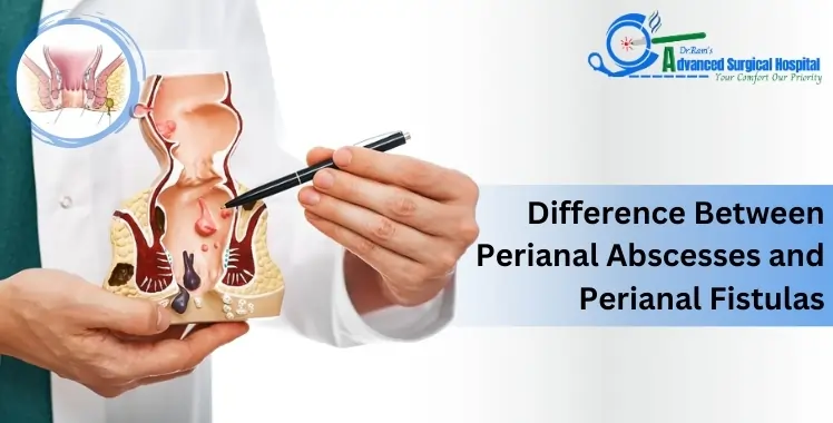 Difference Between Perianal Abscesses and Perianal Fistulas