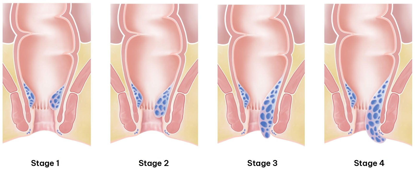 Stages of Piles