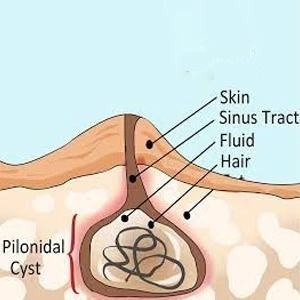 pilonidal sinus treatment