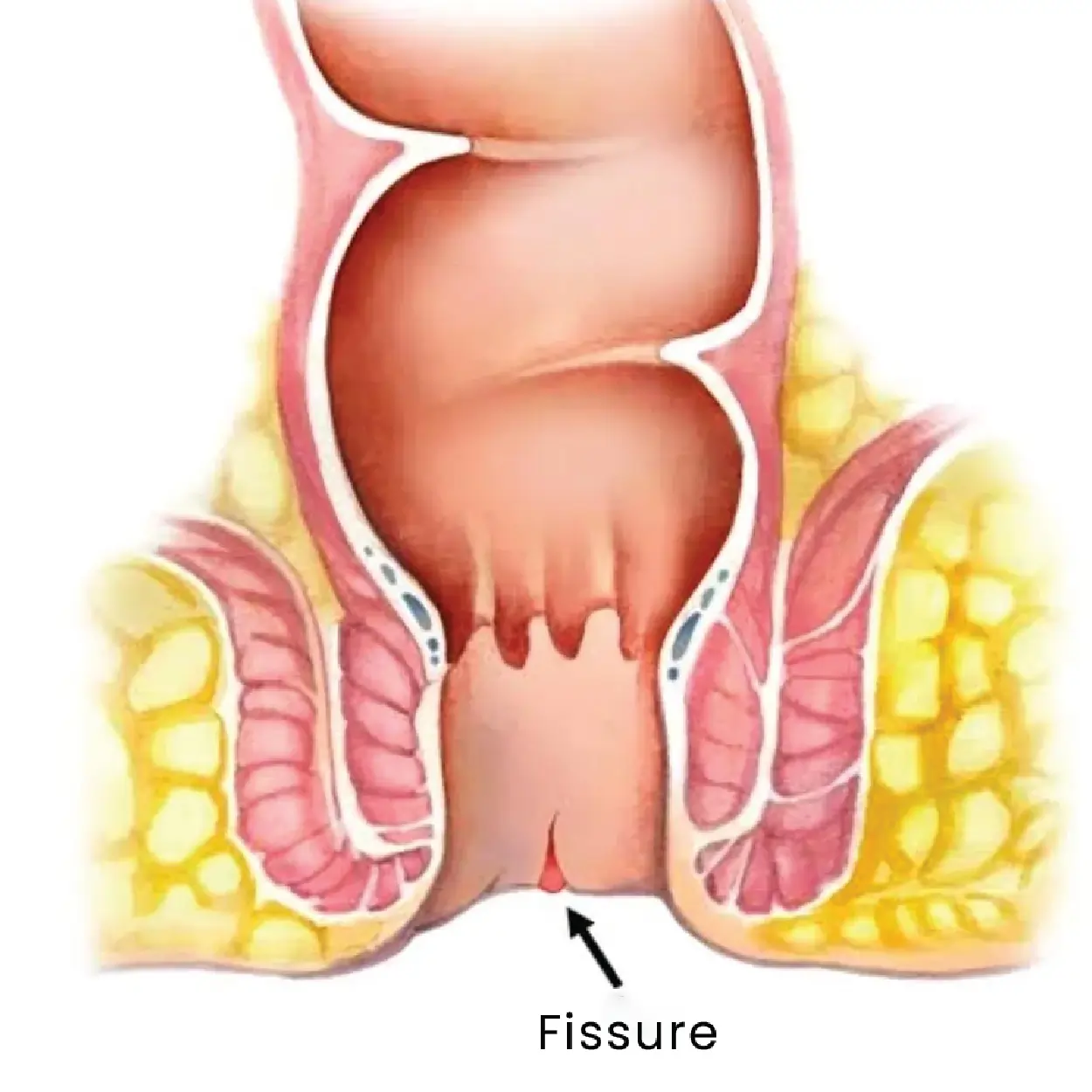 Fissure Treatment