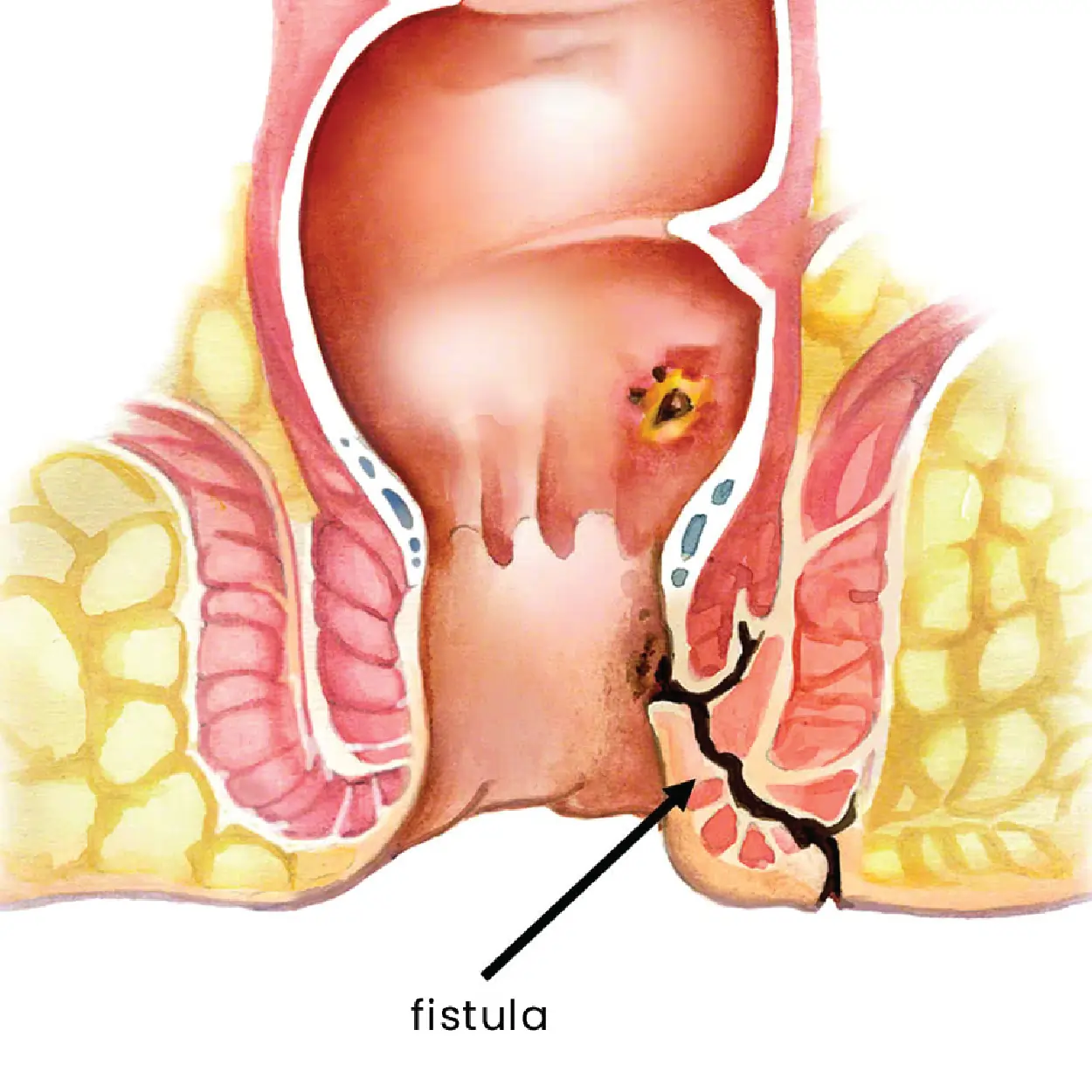 Fistula Treatment